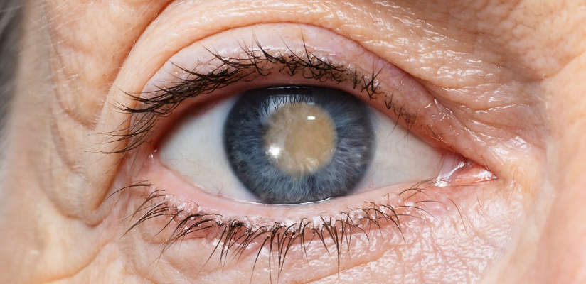 catarata-banners-noticias-412x200